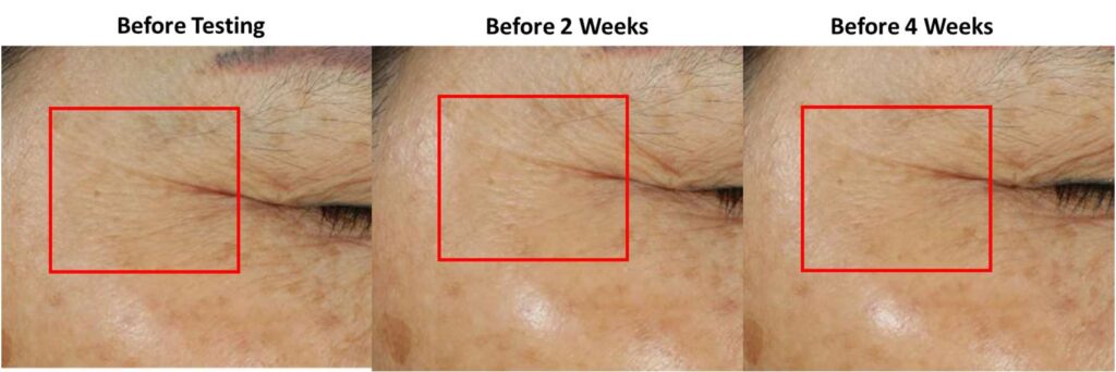 bgt long term anti wrinkle clinical