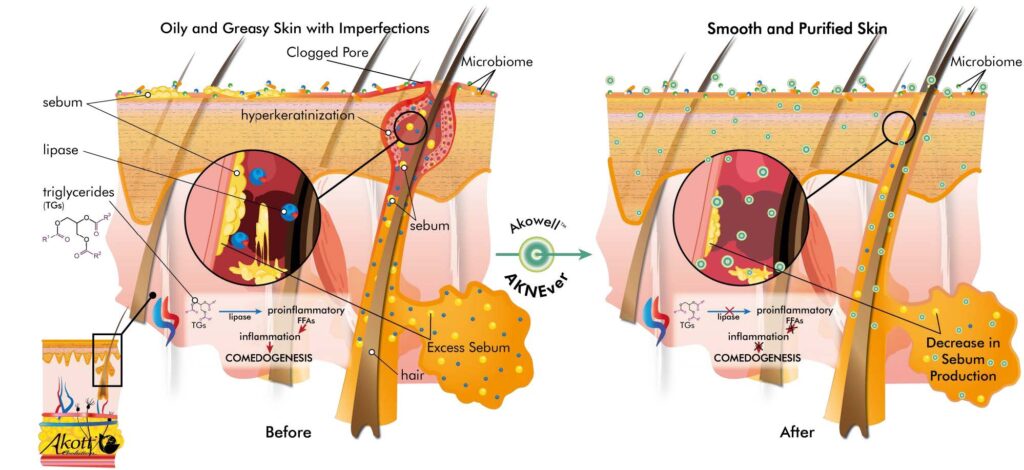 akowell aknever mechanism of action