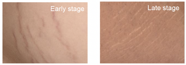 natura tec seawonder stretch marks stages