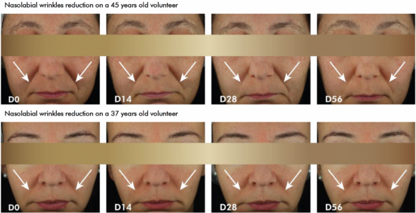 akosky mindlight nasolabial results