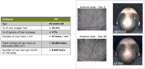 redensyl hair loss stopped details