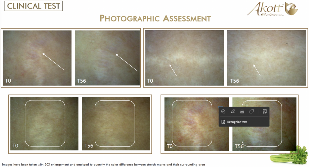 akosky apium clinical test stretch mark reduction