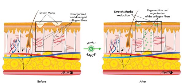 akosky apium mechanism of action stretch marks reduction