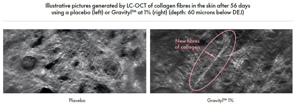 gravityl clinical study 1 collagen density images